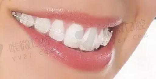 无卡环的活动假牙（活动假牙卡环什么质量好）(图1)